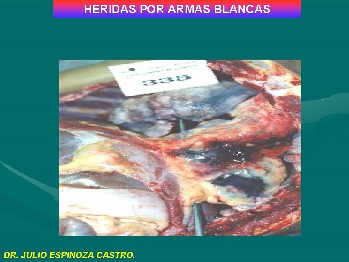 HERIDAS POR ARMAS BLANCAS DR. JULIO ESPINOZA CASTRO. 