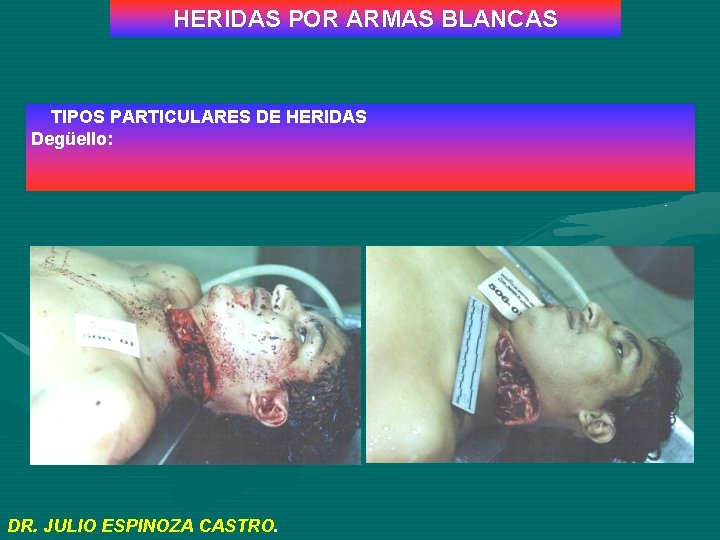 HERIDAS POR ARMAS BLANCAS TIPOS PARTICULARES DE HERIDAS Degüello: DR. JULIO ESPINOZA CASTRO. 