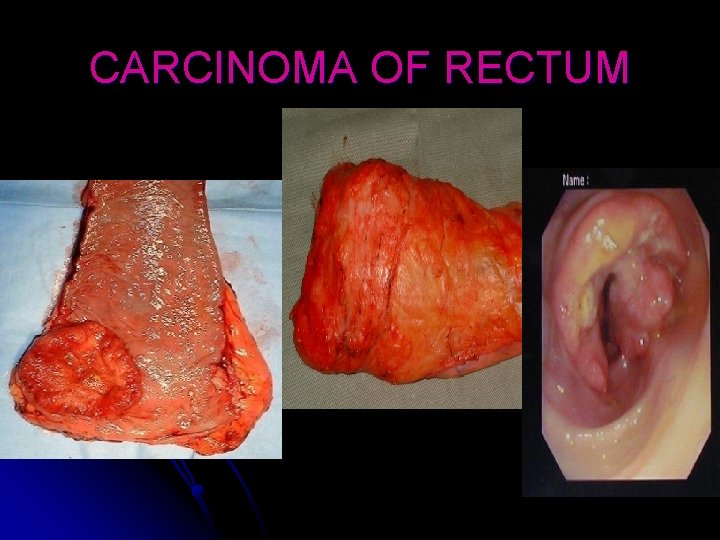 CARCINOMA OF RECTUM 