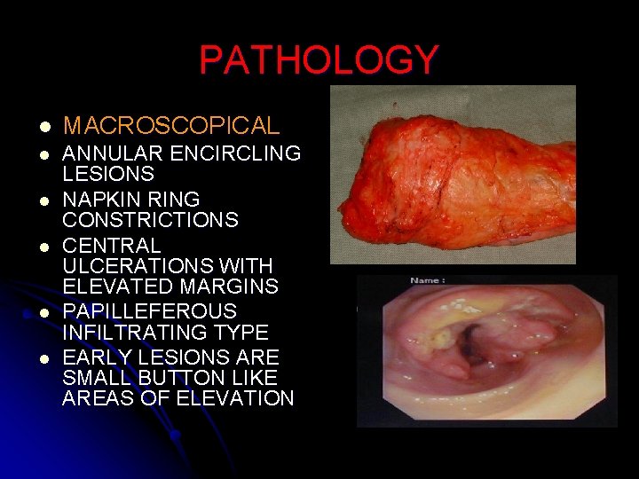 PATHOLOGY l MACROSCOPICAL l ANNULAR ENCIRCLING LESIONS NAPKIN RING CONSTRICTIONS CENTRAL ULCERATIONS WITH ELEVATED