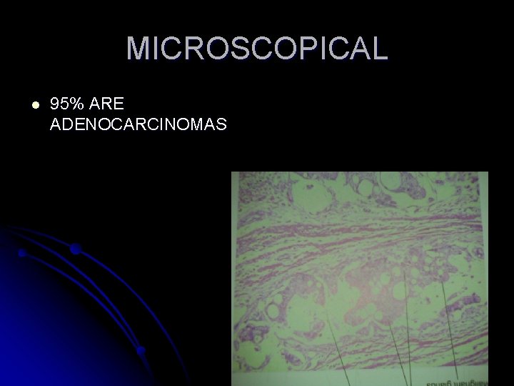 MICROSCOPICAL l 95% ARE ADENOCARCINOMAS 