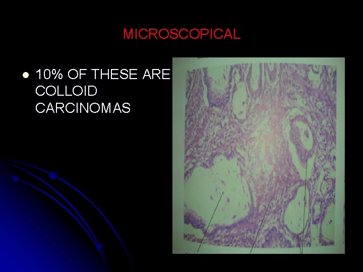 MICROSCOPICAL l 10% OF THESE ARE COLLOID CARCINOMAS 