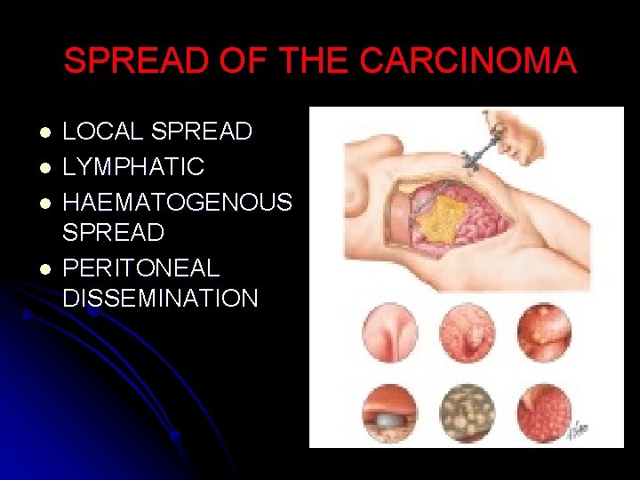 SPREAD OF THE CARCINOMA l l LOCAL SPREAD LYMPHATIC HAEMATOGENOUS SPREAD PERITONEAL DISSEMINATION 