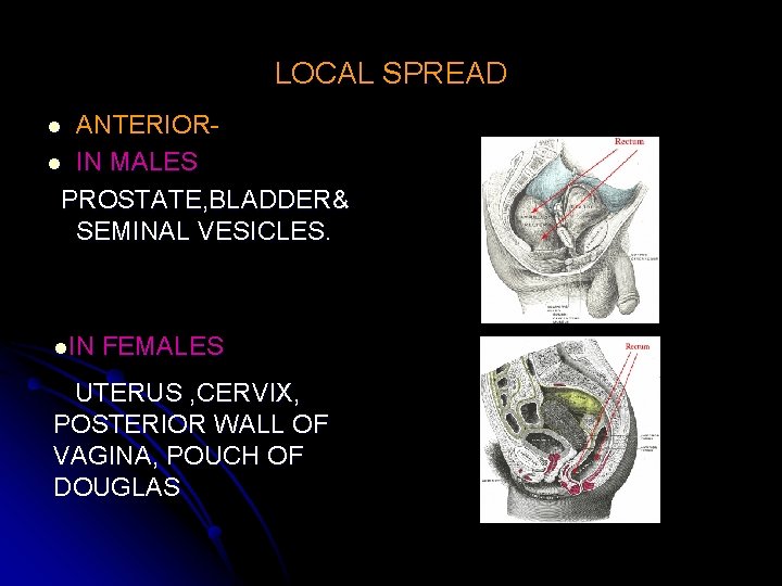 LOCAL SPREAD ANTERIORl IN MALES PROSTATE, BLADDER& SEMINAL VESICLES. l l. IN FEMALES UTERUS