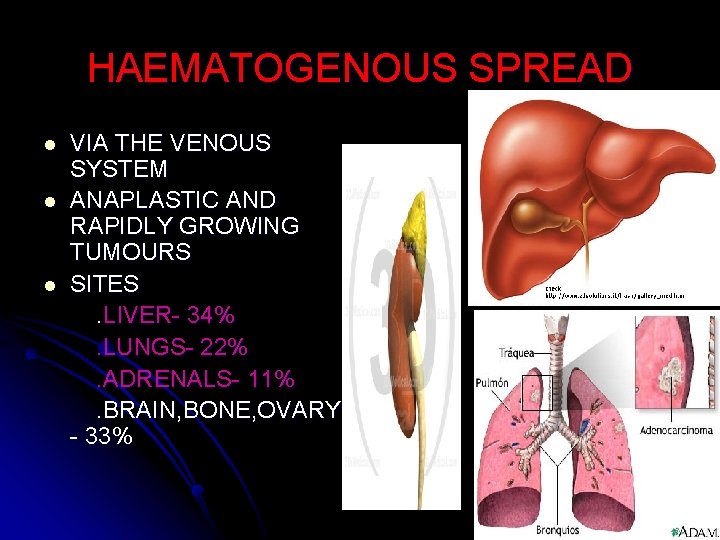 HAEMATOGENOUS SPREAD l l l VIA THE VENOUS SYSTEM ANAPLASTIC AND RAPIDLY GROWING TUMOURS