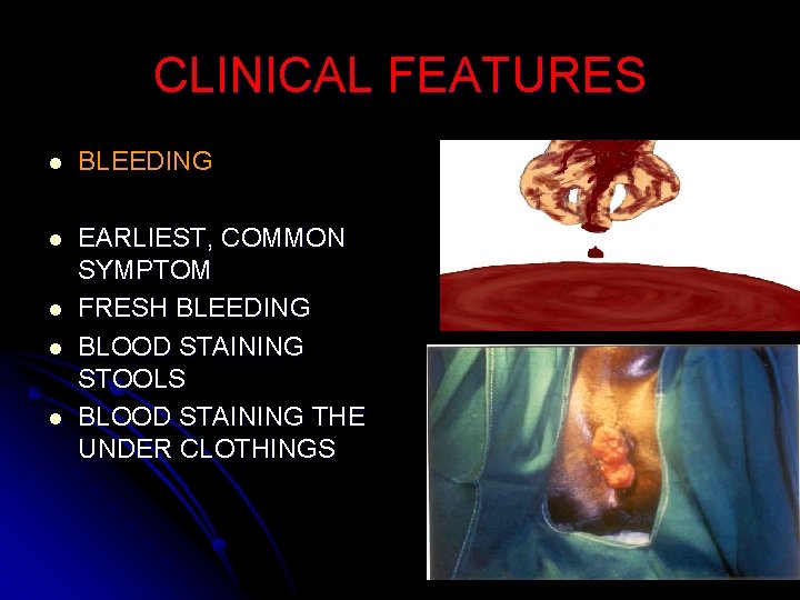 CLINICAL FEATURES l BLEEDING l EARLIEST, COMMON SYMPTOM FRESH BLEEDING BLOOD STAINING STOOLS BLOOD