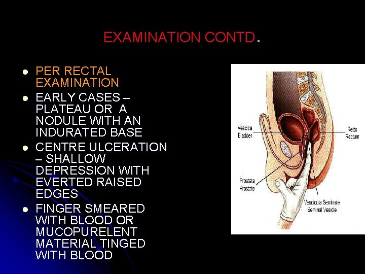 EXAMINATION CONTD. l l PER RECTAL EXAMINATION EARLY CASES – PLATEAU OR A NODULE
