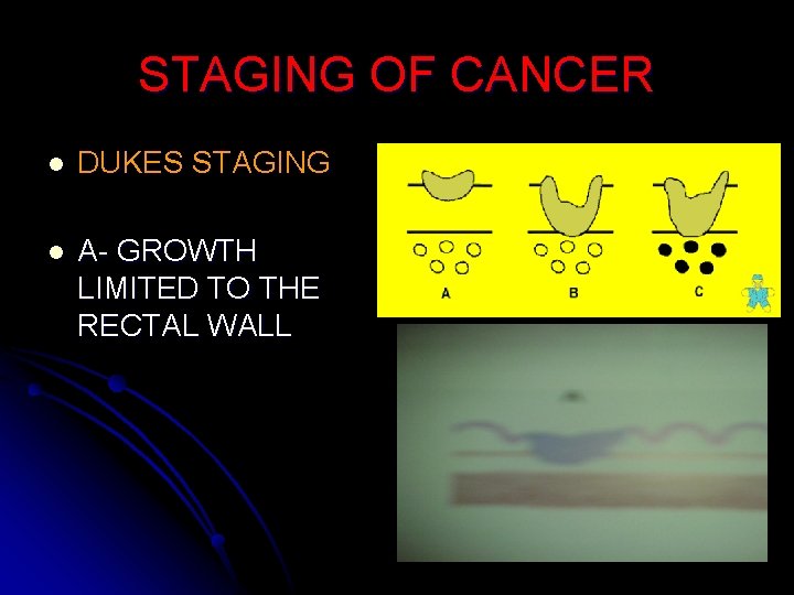 STAGING OF CANCER l DUKES STAGING l A- GROWTH LIMITED TO THE RECTAL WALL