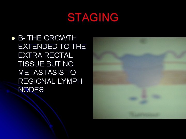 STAGING l B- THE GROWTH EXTENDED TO THE EXTRA RECTAL TISSUE BUT NO METASTASIS