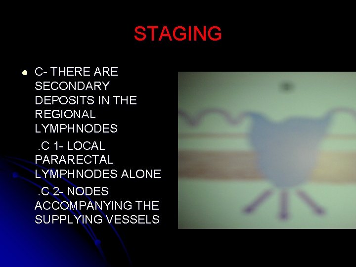 STAGING l C- THERE ARE SECONDARY DEPOSITS IN THE REGIONAL LYMPHNODES. C 1 -