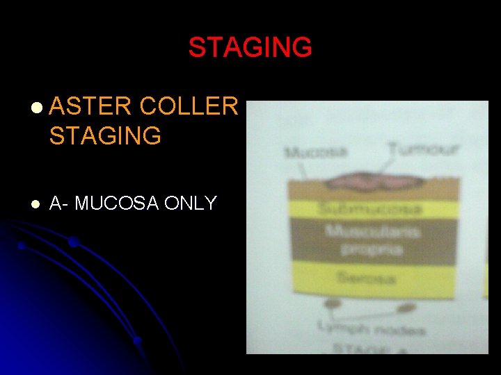 STAGING l ASTER COLLER STAGING l A- MUCOSA ONLY 