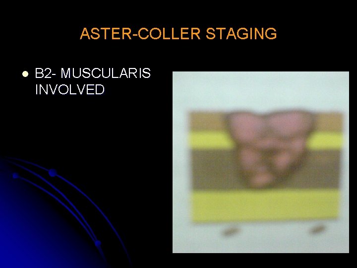 ASTER-COLLER STAGING l B 2 - MUSCULARIS INVOLVED 