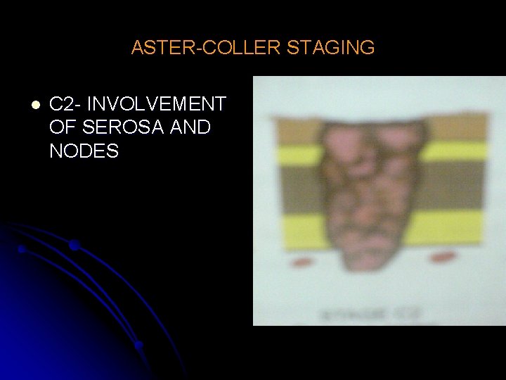 ASTER-COLLER STAGING l C 2 - INVOLVEMENT OF SEROSA AND NODES 