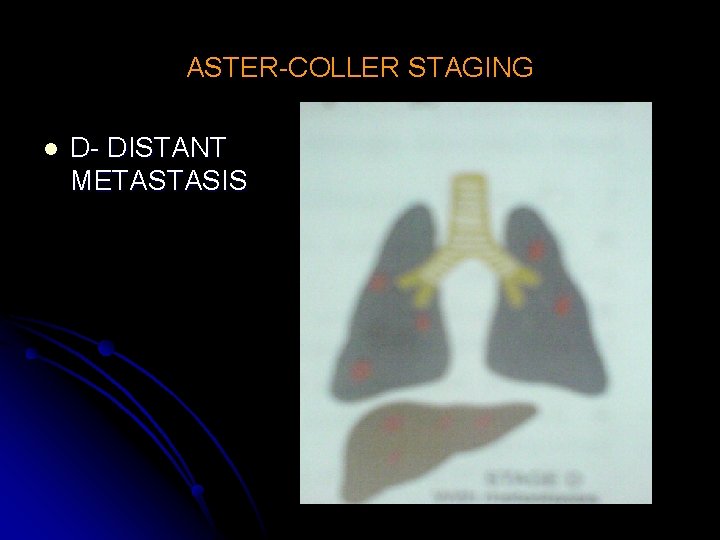 ASTER-COLLER STAGING l D- DISTANT METASTASIS 