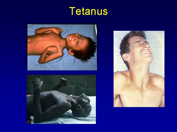 Tetanus 