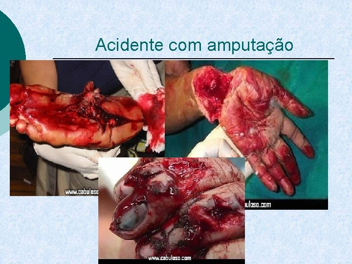 Acidente com amputação 