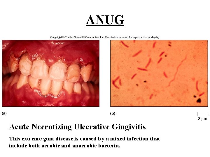 ANUG Acute Necrotizing Ulcerative Gingivitis This extreme gum disease is caused by a mixed