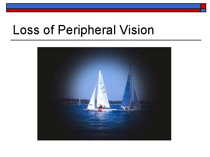 Loss of Peripheral Vision 