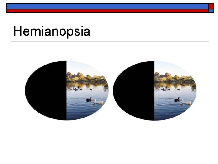 Hemianopsia 