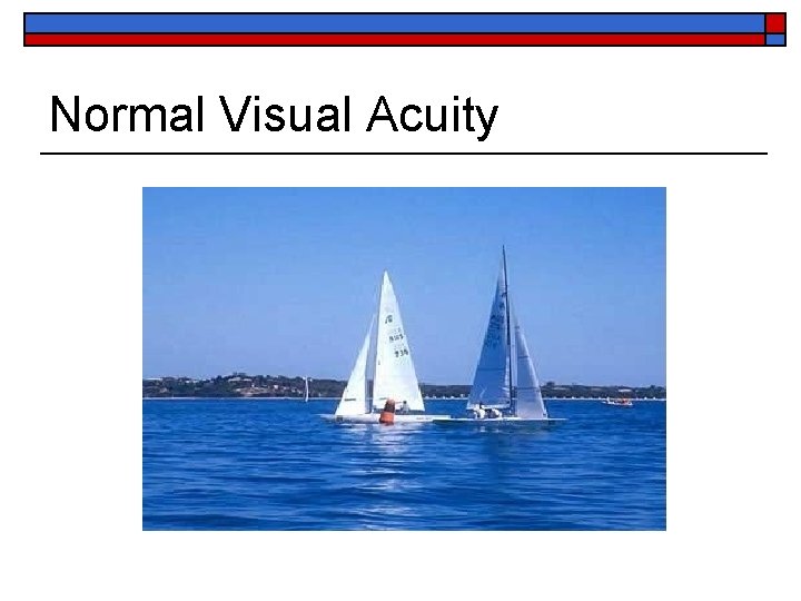 Normal Visual Acuity 