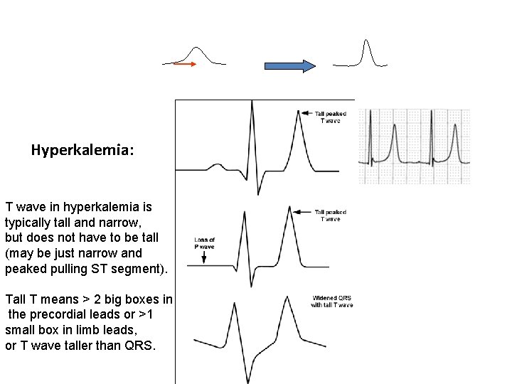 Hyperkalemia: T wave in hyperkalemia is typically tall and narrow, but does not have