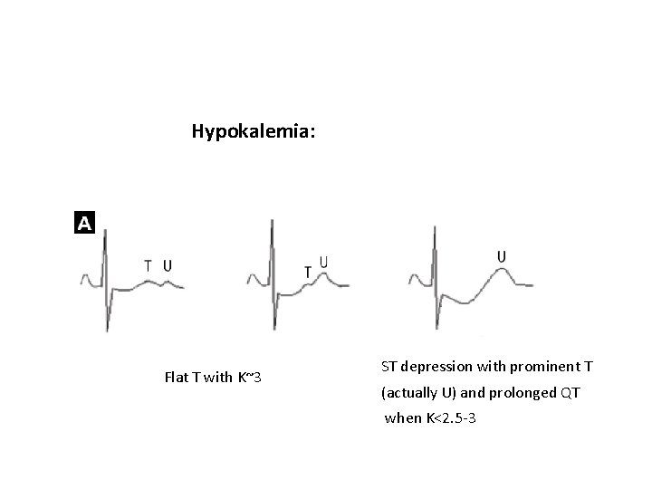 Hypokalemia: Flat T with K~3 ST depression with prominent T (actually U) and prolonged