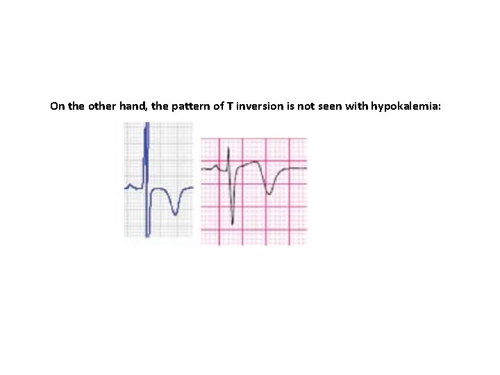 On the other hand, the pattern of T inversion is not seen with hypokalemia: On the other hand, the pattern of T inversion is not seen with hypokalemia:
