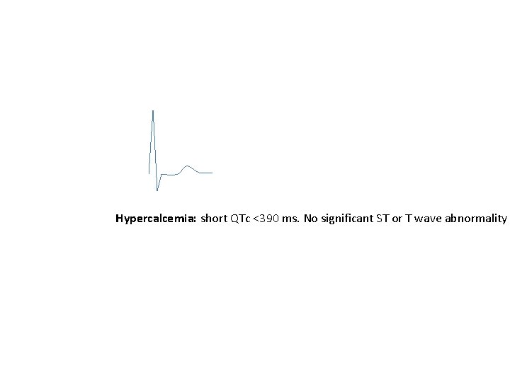 Hypercalcemia: short QTc <390 ms. No significant ST or T wave abnormality 