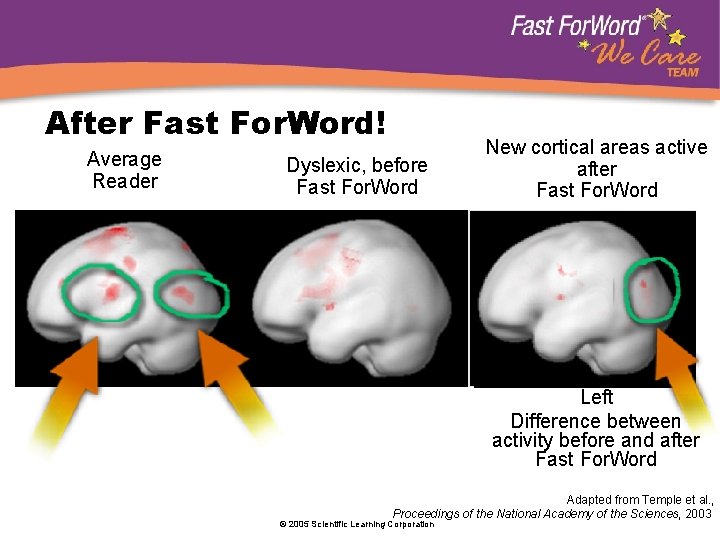 After Fast For. Word! Average Reader Dyslexic, before Fast For. Word Dyslexic Reader before