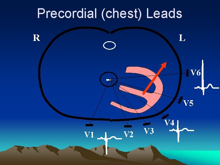Precordial (chest) Leads R L V 6 - V 5 V 1 V 2