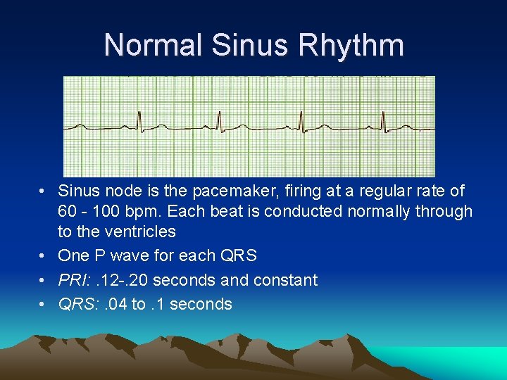 Normal Sinus Rhythm • Sinus node is the pacemaker, firing at a regular rate