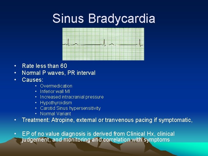 Sinus Bradycardia • Rate less than 60 • Normal P waves, PR interval •