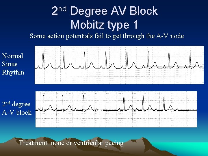 2 nd Degree AV Block Mobitz type 1 Some action potentials fail to get