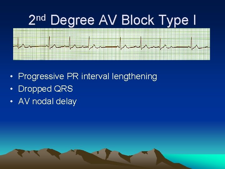 2 nd Degree AV Block Type I • Progressive PR interval lengthening • Dropped