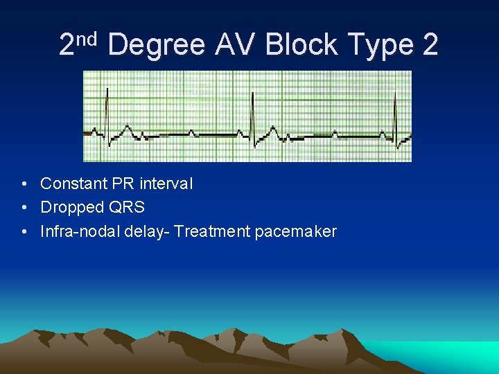 2 nd Degree AV Block Type 2 • Constant PR interval • Dropped QRS