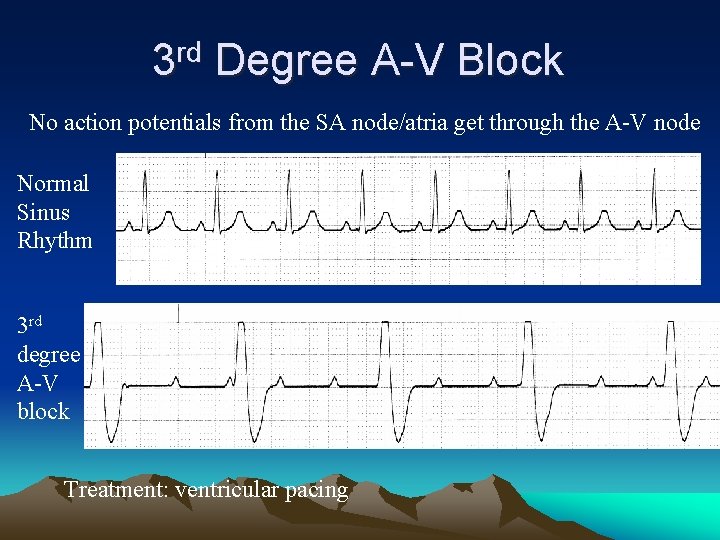 3 rd Degree A-V Block No action potentials from the SA node/atria get through