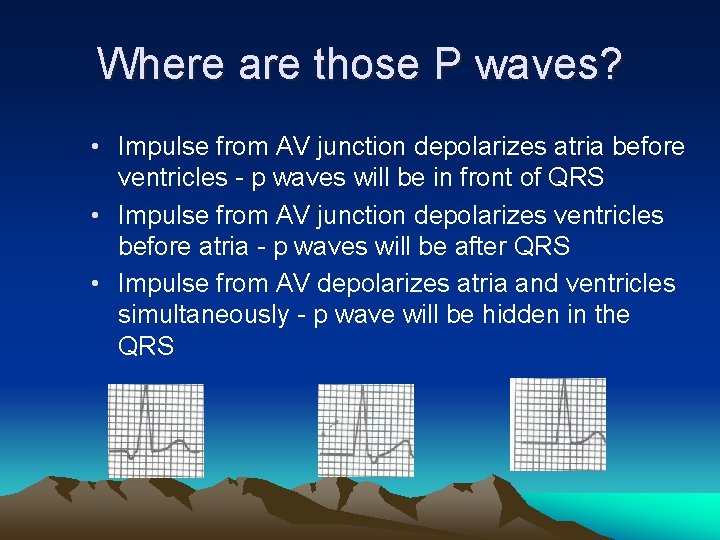 Where are those P waves? • Impulse from AV junction depolarizes atria before ventricles