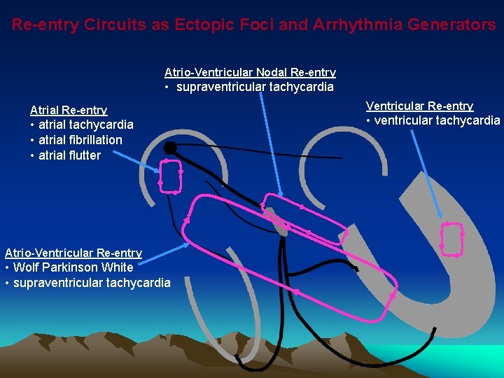 Re-entry Circuits as Ectopic Foci and Arrhythmia Generators Atrio-Ventricular Nodal Re-entry • supraventricular tachycardia