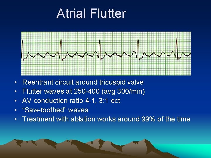 Atrial Flutter • • • Reentrant circuit around tricuspid valve Flutter waves at 250