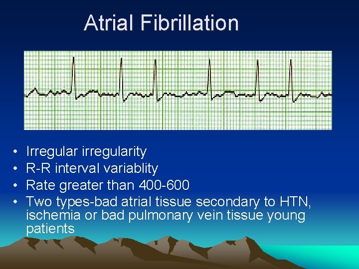 Atrial Fibrillation • • Irregular irregularity R-R interval variablity Rate greater than 400 -600