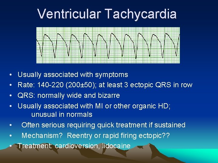 Ventricular Tachycardia • • Usually associated with symptoms Rate: 140 -220 (200± 50); at