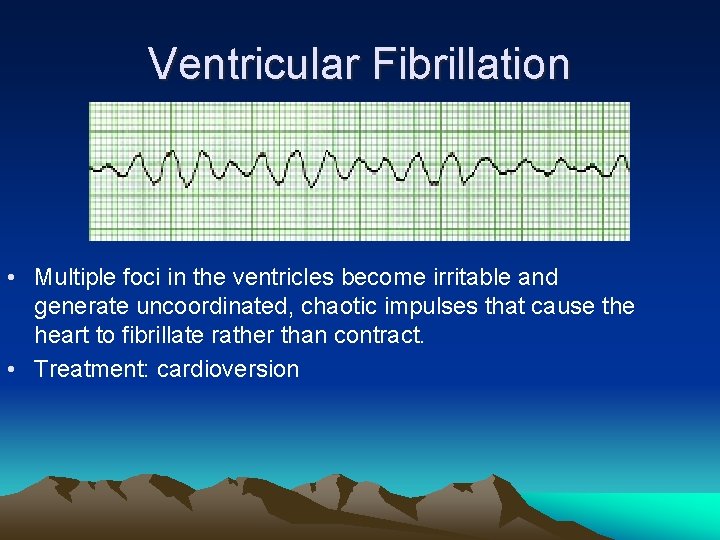Ventricular Fibrillation • Multiple foci in the ventricles become irritable and generate uncoordinated, chaotic