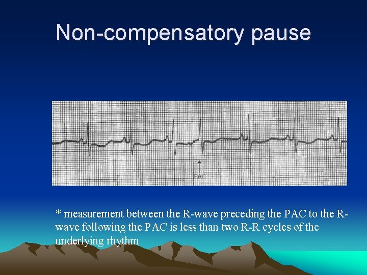 Non-compensatory pause * measurement between the R-wave preceding the PAC to the Rwave following