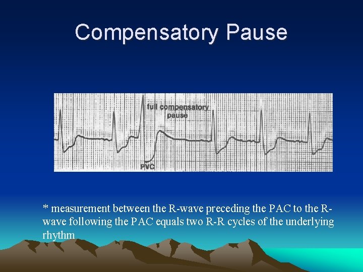 Compensatory Pause * measurement between the R-wave preceding the PAC to the Rwave following