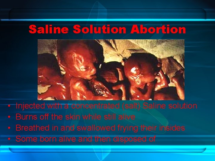 Saline Solution Abortion • • Injected with a concentrated (salt) Saline solution Burns off