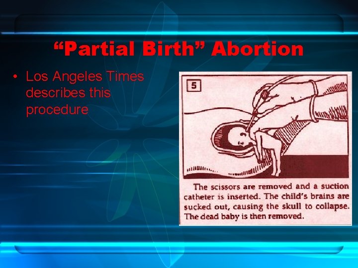 “Partial Birth” Abortion • Los Angeles Times describes this procedure 