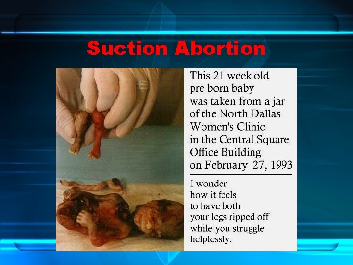 Suction Abortion 