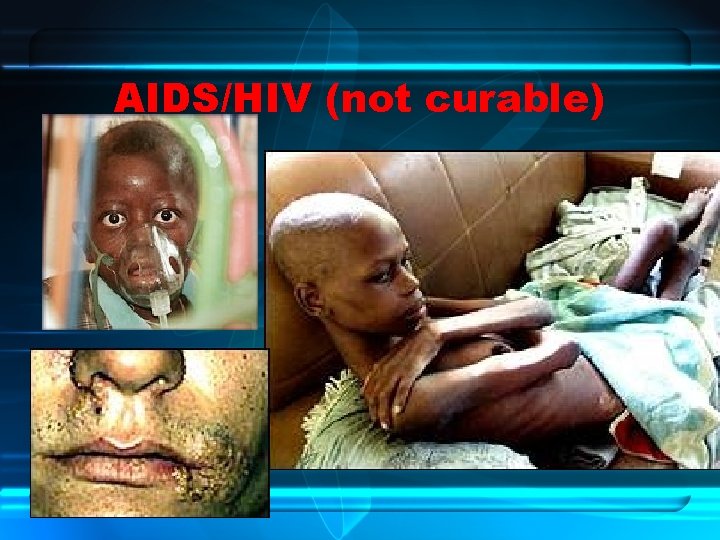 AIDS/HIV (not curable) 