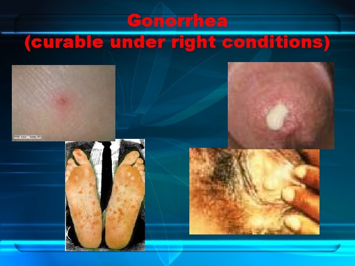 Gonorrhea (curable under right conditions) 