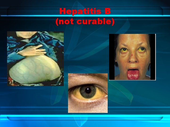 Hepatitis B (not curable) 